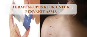 Terapi akupuntur untuk asma di ciledug