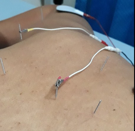 Cara Mengatasi Darah Kental Dengan Tusuk Jarum di Jakarta