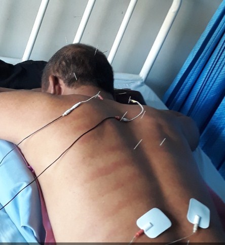 Cara Mengatasi Darah Kental Dengan Tusuk Jarum di Tangerang