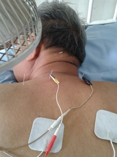 Cara Mengobati Anxieti dengan Akupuntur dan Herbal di Tangerang