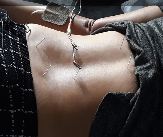 Cara Mengobati Asam Lambung dengan Akupuntur dan Herbal di Tangerang