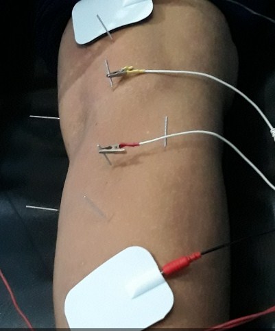 Cara Mengobati Asam Urat Tinggi Dengan Akupuntur dan Herbal di Jakarta