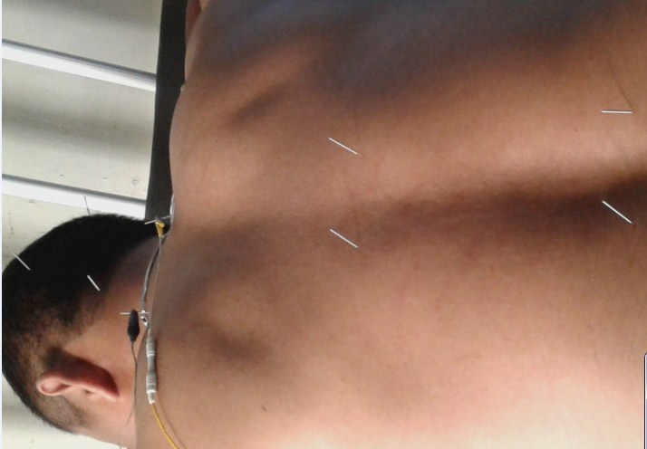 Cara Mengobati Impoten dengan Akupuntur dan Herbal di Jakarta