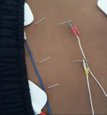 Cara Mengobati Insomnia Dengan Tusuk Jarum di Jakarta