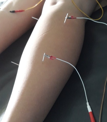 Cara Mengobati Kesemutan Dengan Akupuntur dan Herbal di Jakarta