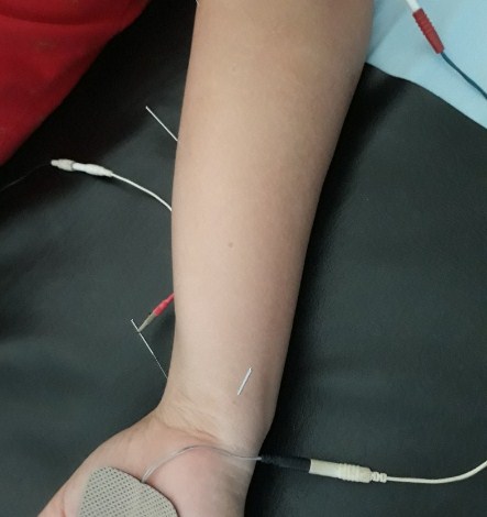 Cara Mengobati Kolesterol Tinggi dengan Akupuntur dan Herbal di Tangerang