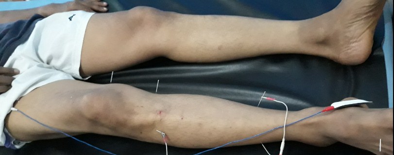 Cara Mengobati Lemah Syahwat Dengan Akupuntur dan Herbal di Tangerang