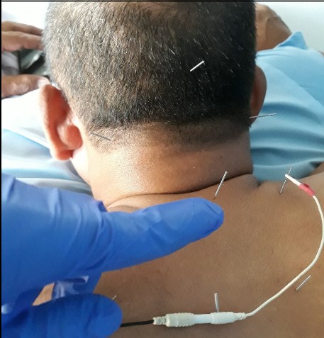 Cara Mengobati Migrain Dengan Akupuntur dan Herbal di Jakarta