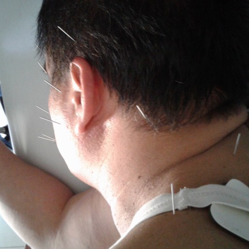 Cara Mengobati Migrain dengan Akupuntur Dan Herbal di Tangerang