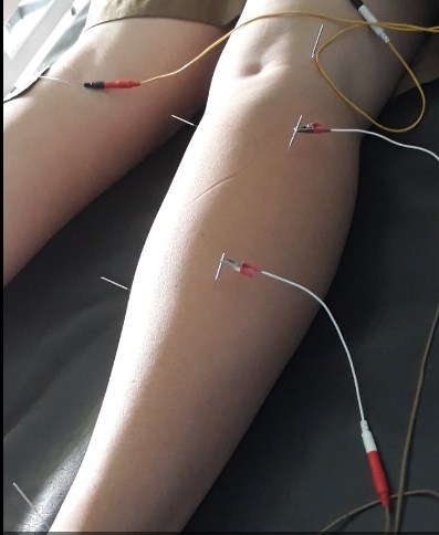 Cara Mengobati Nyeri Sendi Dengan Akupuntur dan Herbal di Jakarta