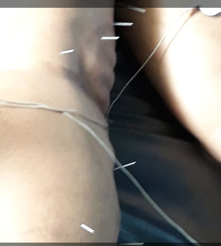 Cara Mengobati Nyeri Sendi Dengan Akupuntur dan Herbal di Tangerang