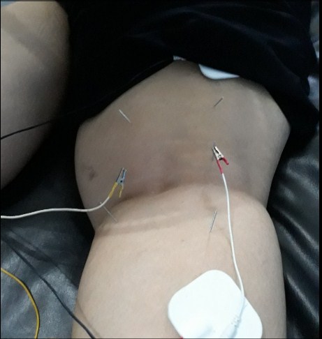 Cara Mengobati Pengapuran Dengan Akupuntur dan Herbal di Jakarta