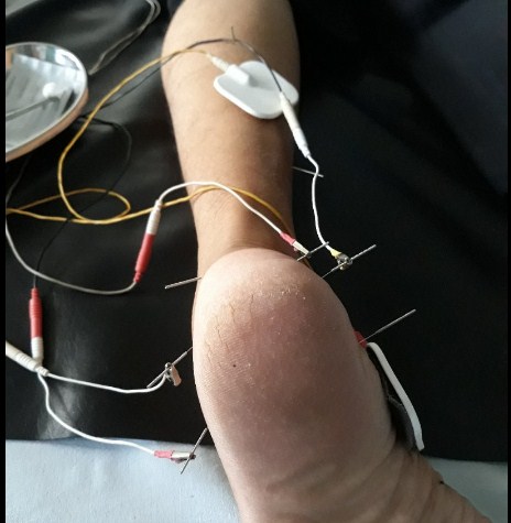 Cara mengobati kaki baal dengan tusuk jarum di Tangerang