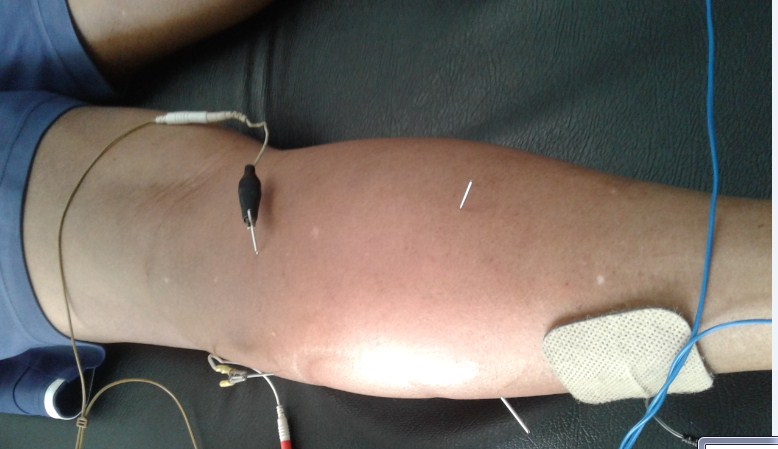 Cara Mengobati Rematik Dengan Akupuntur dan Herbal di Jakarta