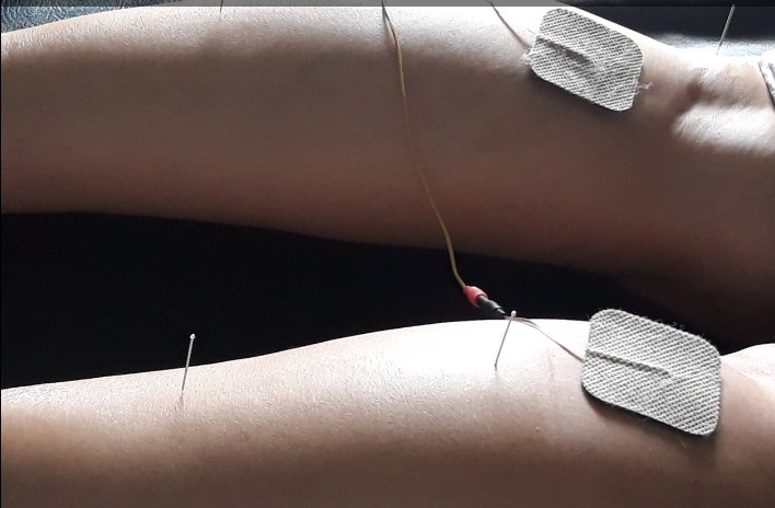 Cara Mengobati Rematik Dengan Akupuntur dan Herbal di Tangerang