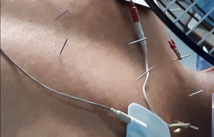 Cara Mengobati Sakit Pinggang dengan Akupuntur dan Herbal di Tangerang