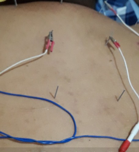 Cara Mengobati Sakit Punggung Dengan Tusuk Jarum di Tangerang