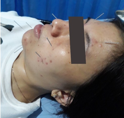 terapi akupuntur untuk kecantikan wajah
