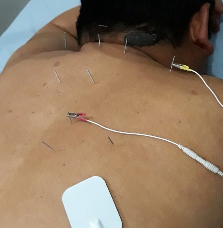 Cara Mengobati Susah Tidur Dengan Akupuntur dan Herbal di Jakarta