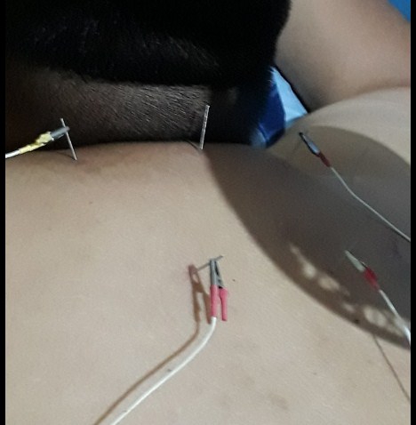 Cara Mengobati Syaraf Kejepit dengan Akupuntur dan Herbal di Jakarta