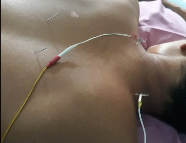 Cara Mengobati Syaraf Muka Lumpuh Dengan Akupuntur dan Herbal di Jakarta