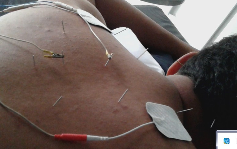 Cara Mengobati Tukak Lambung dengan Tusuk Jarum di Jakarta