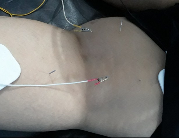 Cara Mengobati Tukak Lambung dengan Tusuk Jarum di Tangerang