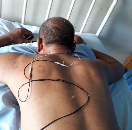 Cara Mengobati Vertigo Dengan Akupuntur dan Herbal di Tangerang