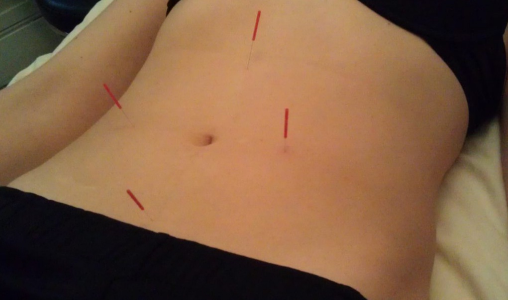 Klinik akupuntur pelangsingan di dekat Jakarta 081908284999