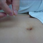 Cara Mengobati Gangguan Prostat dengan Terapi Akupuntur