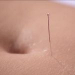 Cara Mengobati Nyeri Menstruasi dengan Terapi Akupuntur