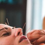 Mulut Miring Efektif Diatasi Menggunakan Akupuntur