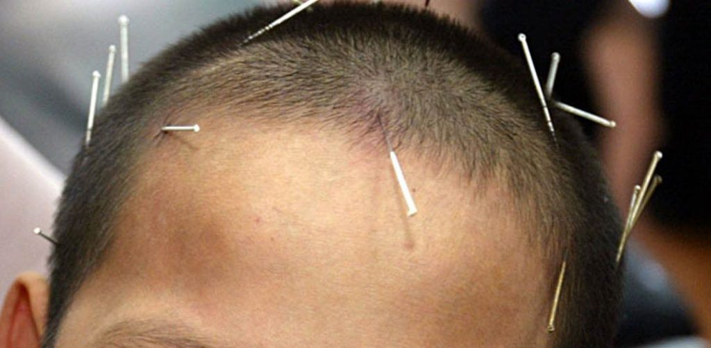 Manfaat Terapi Tusuk Jarum Untuk Stroke