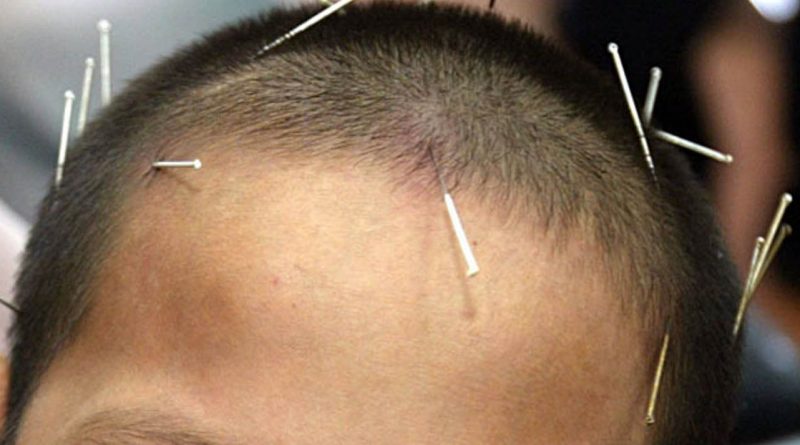 Jarum tusuk manfaat akupuntur Manfaat Akupunktur