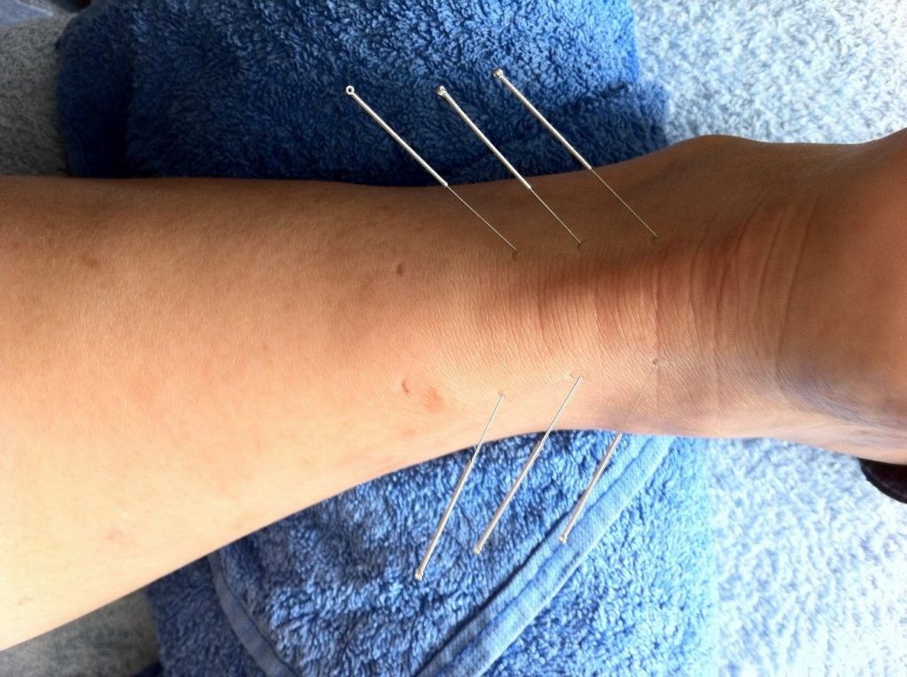 Cara Mengobati Stroke Ringan Pada Kaki