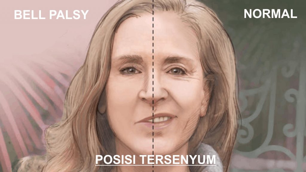 Pantangan Makanan Penderita Mulut Miring Bell’s Palsy
