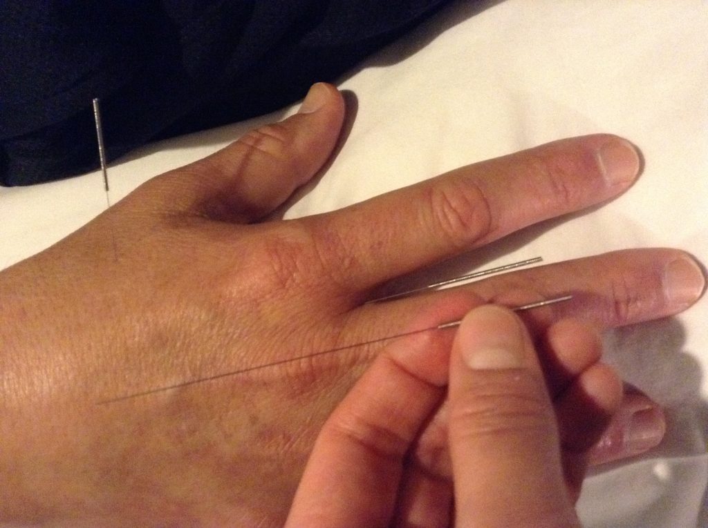 Cara Mengobati Stroke Dengan Terapi Tusuk Jarum di Alam Sutera