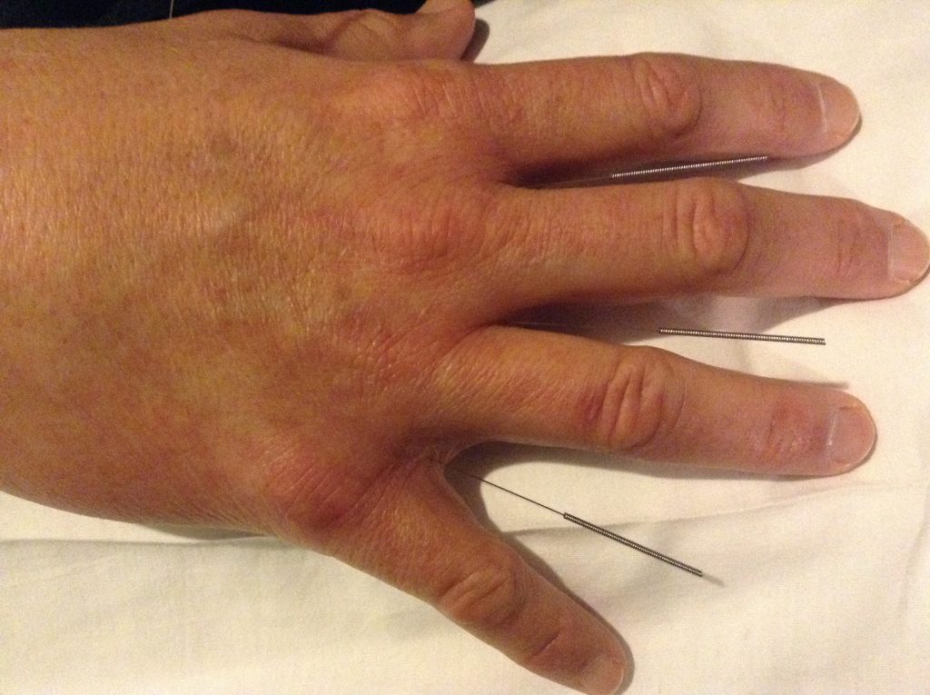 Cara Mengobati Stroke Dengan Terapi Tusuk Jarum di Bintaro