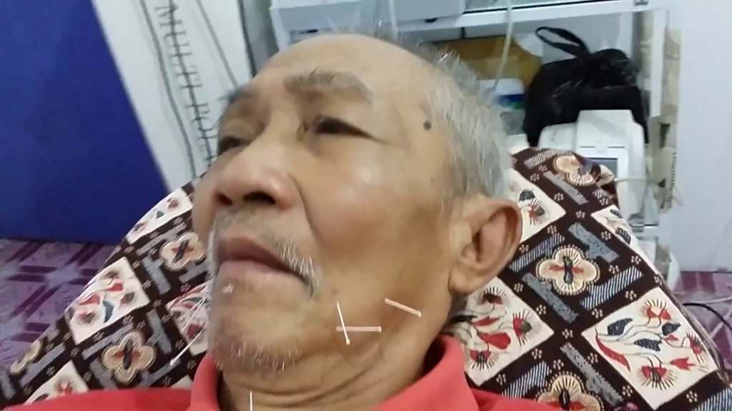 Cara Mengobati Stroke dengan Terapi Tusuk Jarum di Ciledug