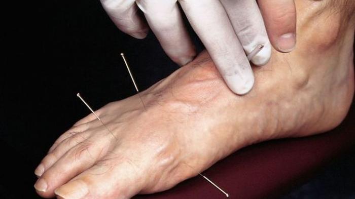 Cara Mengobati Stroke dengan Terapi Tusuk Jarum di Serpong