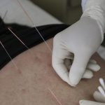 Manfaat Terapi Akupuntur untuk Daya Tahan Tubuh Tetap Fit