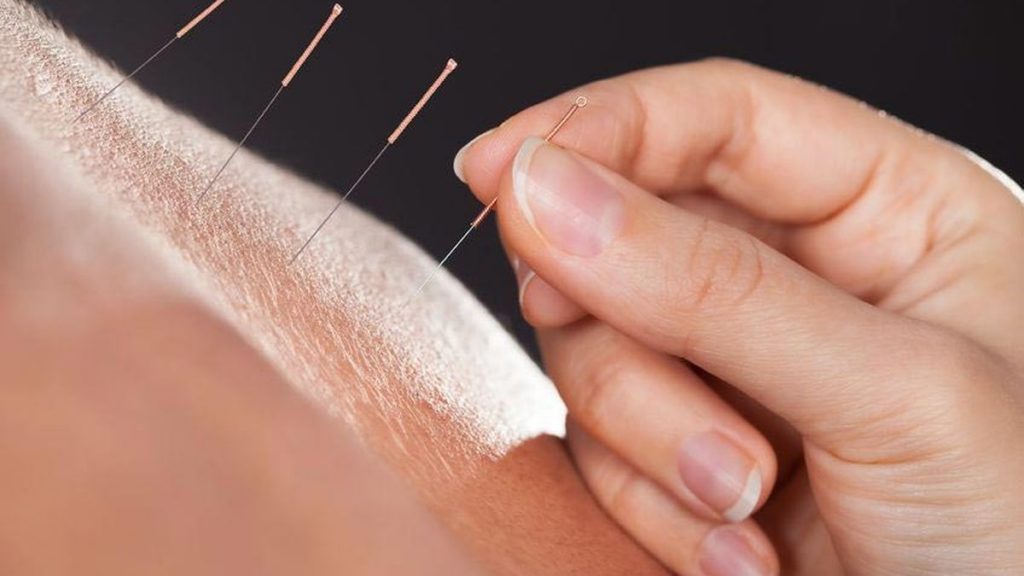 Manfaat Terapi Akupuntur untuk Kebugaran