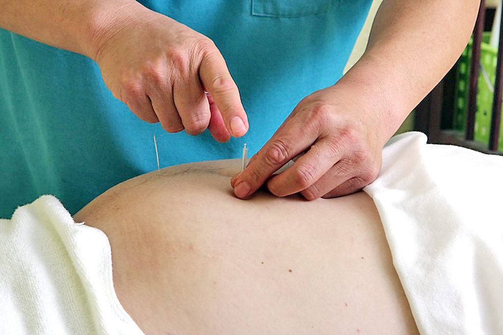 Terapi Akupuntur untuk Mengatasi Perut Kembung