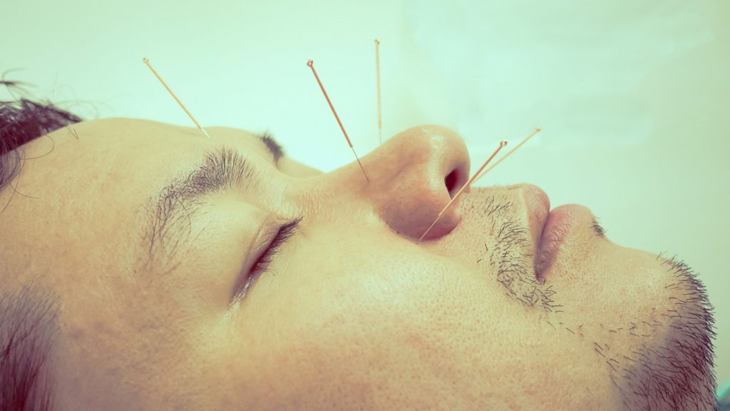 Terapi Akupuntur untuk Pemulihan Pasca Sakit