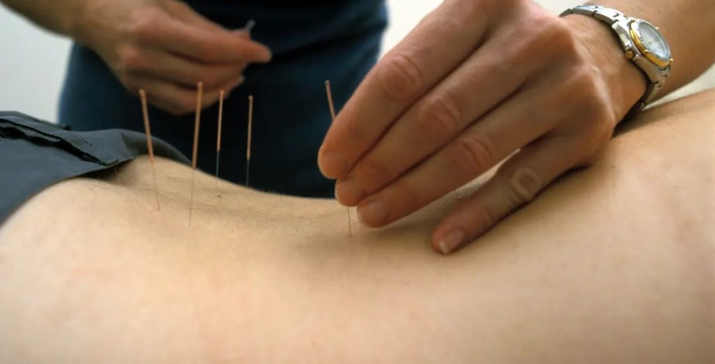 Cara Mengobati Nyeri Pinggang dengan Akupuntur dan Herbal di Tangerang