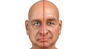 Cara Mengobati Sakit Mulut Miring Bellspalsy Dengan Terapi Jarak Jauh Bersama Sinshe Toto