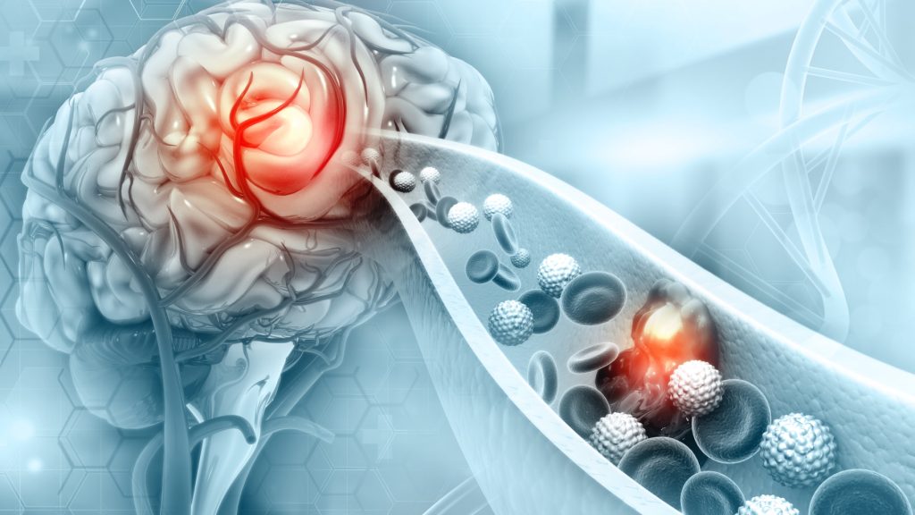 Manfaat Angkung Niu Huang Wan dan Bahaya Stroke Diam-Diam di Usia Produktif