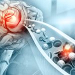 Manfaat Angkung Niu Huang Wan dan Bahaya Stroke Diam-Diam di Usia Produktif