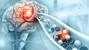 Manfaat Angkung Niu Huang Wan dan Bahaya Stroke Diam-Diam di Usia Produktif