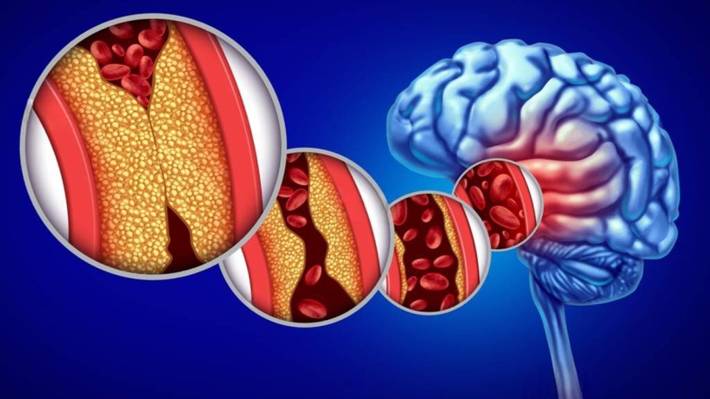 Obat Stroke China Paling Ampuh bagi Pasien Hipertensi Usia 40+ Jangan Tunggu Serangan Datang